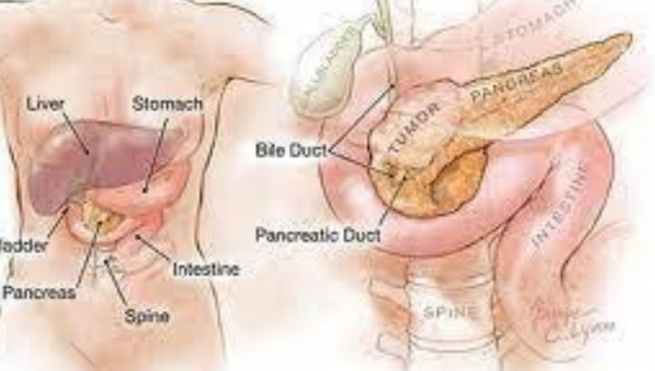 علاج سرطان البنكرياس في الهند